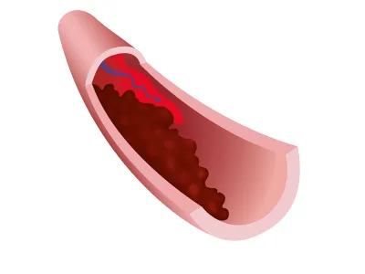 The formation of a blood clot